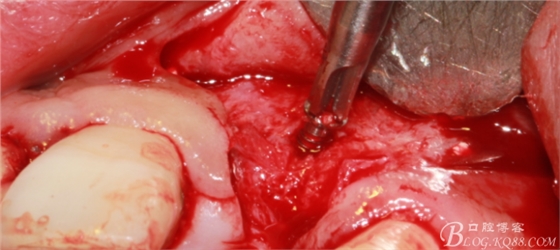 一例上前牙種植失敗病例的補(bǔ)救(梁光強(qiáng)) 一例上前牙種植失敗病例的補(bǔ)救(梁光強(qiáng))