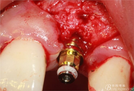 一例上前牙種植失敗病例的補(bǔ)救(梁光強(qiáng)) 一例上前牙種植失敗病例的補(bǔ)救(梁光強(qiáng))