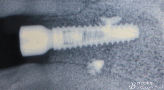 一例上前牙種植失敗病例的補(bǔ)救(梁光強(qiáng)) 一例上前牙種植失敗病例的補(bǔ)救(梁光強(qiáng))