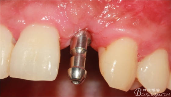 一例上前牙種植失敗病例的補(bǔ)救(梁光強(qiáng)) 一例上前牙種植失敗病例的補(bǔ)救(梁光強(qiáng))