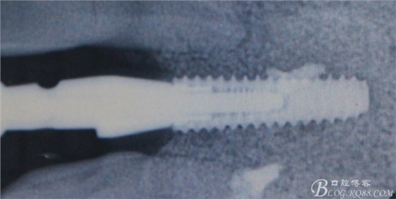 一例上前牙種植失敗病例的補(bǔ)救(梁光強(qiáng)) 一例上前牙種植失敗病例的補(bǔ)救(梁光強(qiáng))