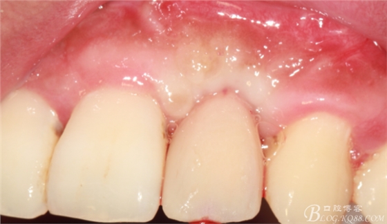 一例上前牙種植失敗病例的補(bǔ)救(梁光強(qiáng)) 一例上前牙種植失敗病例的補(bǔ)救(梁光強(qiáng))