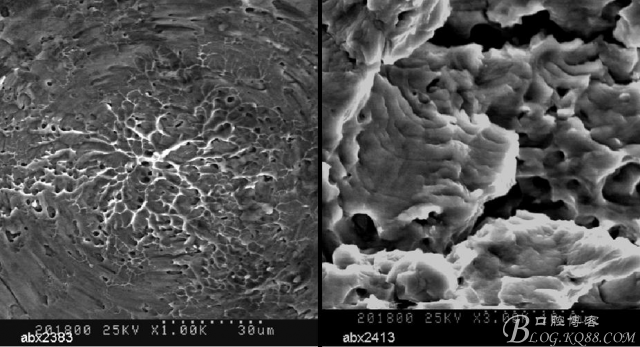 彭彬:鎳鈦根管器械折斷的類型及預防要點(修改版) 彭彬:鎳鈦根管器械折斷的類型及預防要點(修改版)