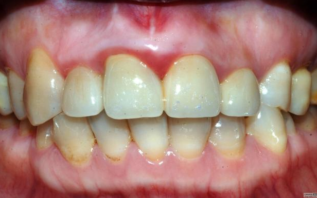 認(rèn)真看待根管治療在醫(yī)院診所技術(shù)中的地位 認(rèn)真看待根管治療在醫(yī)院診所技術(shù)中的地位