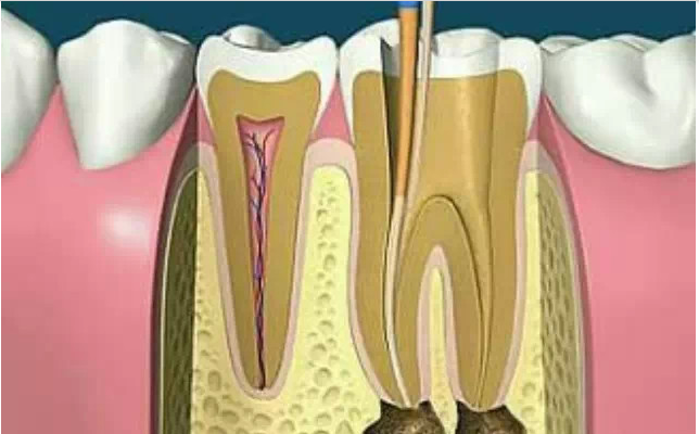 尋找根管口的八種方法 尋找根管口的八種方法