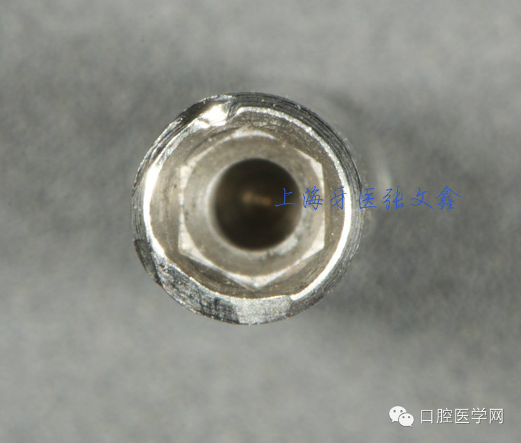 種植替代體上的細節(jié)不可忽視 種植替代體上的細節(jié)不可忽視