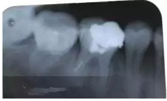 根管治療中斷針及處理方法 根管治療中斷針及處理方法