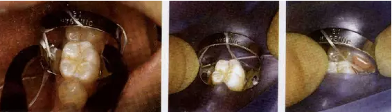 橡皮障的四種安裝方法以及疑難處理 橡皮障的四種安裝方法以及疑難處理