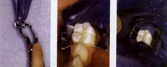 橡皮障的四種安裝方法以及疑難處理 橡皮障的四種安裝方法以及疑難處理