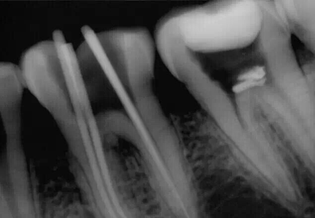 牙醫(yī)的“癢癢”—— 斷針 牙醫(yī)的“癢癢”—— 斷針