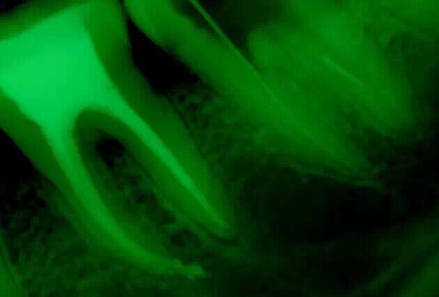 牙醫(yī)的“癢癢”—— 斷針 牙醫(yī)的“癢癢”—— 斷針