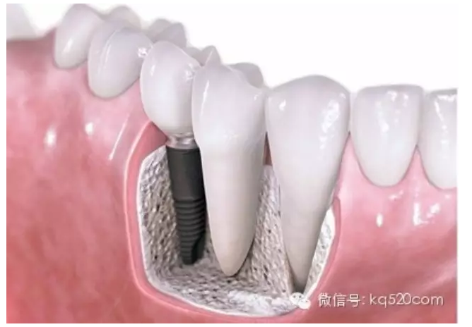 有關(guān)種植牙的一些常見問題問答 有關(guān)種植牙的一些常見問題問答