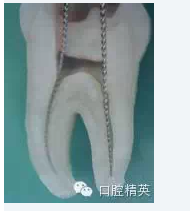 彎曲根管預(yù)備的方法和技巧 彎曲根管預(yù)備的方法和技巧