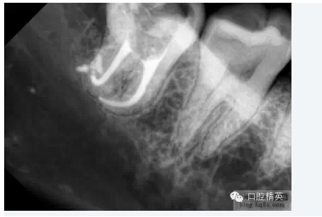 彎曲根管預(yù)備的方法和技巧 彎曲根管預(yù)備的方法和技巧