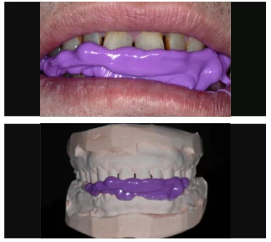 瓷貼面實戰(zhàn)流程 瓷貼面實戰(zhàn)流程