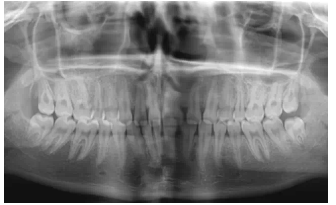 瓷貼面實戰(zhàn)流程 瓷貼面實戰(zhàn)流程