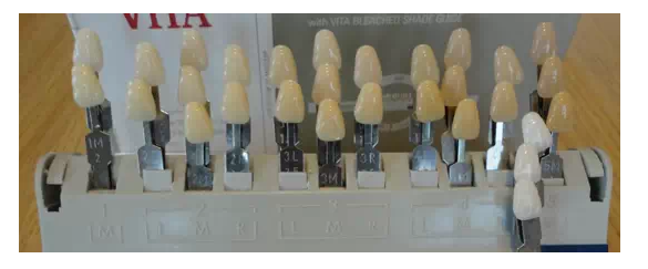 瓷貼面實戰(zhàn)流程 瓷貼面實戰(zhàn)流程