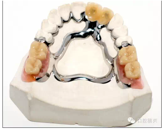 如何選擇活動(dòng)義齒支架的合金 如何選擇活動(dòng)義齒支架的合金