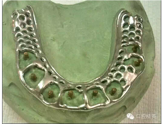 如何選擇活動(dòng)義齒支架的合金 如何選擇活動(dòng)義齒支架的合金