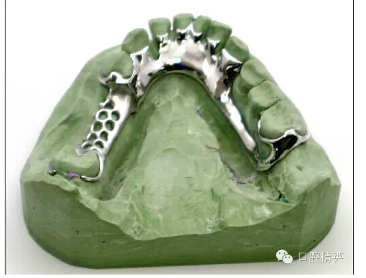 如何選擇活動(dòng)義齒支架的合金 如何選擇活動(dòng)義齒支架的合金