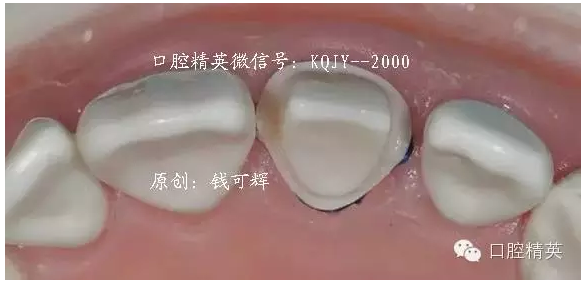 為什么你的牙齒備不好 為什么你的牙齒備不好