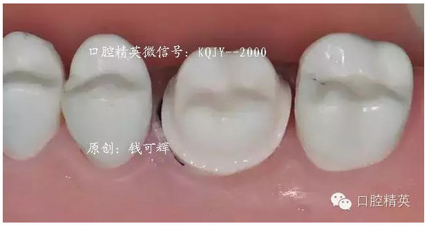 為什么你的牙齒備不好 為什么你的牙齒備不好
