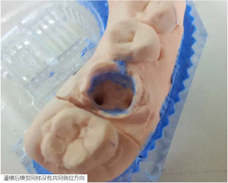 氧化鋯樁核后牙根管有倒凹設(shè)計 氧化鋯樁核后牙根管有倒凹設(shè)計