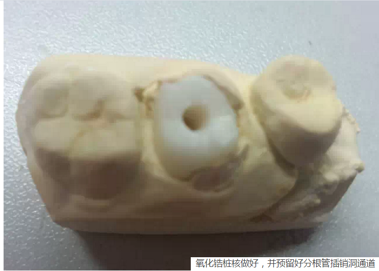 氧化鋯樁核后牙根管有倒凹設(shè)計 氧化鋯樁核后牙根管有倒凹設(shè)計
