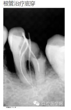 幾張失敗的根管治療x線診斷 幾張失敗的根管治療x線診斷