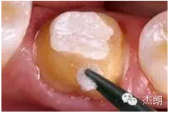 即刻牙本質(zhì)封閉 即刻牙本質(zhì)封閉