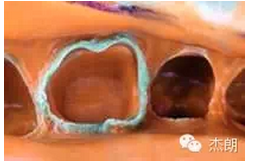 即刻牙本質(zhì)封閉 即刻牙本質(zhì)封閉