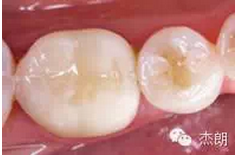 即刻牙本質(zhì)封閉 即刻牙本質(zhì)封閉