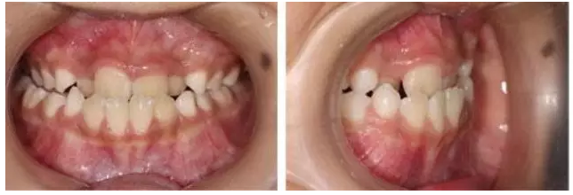 “地包天”的最佳治療時(shí)間 “地包天”的最佳治療時(shí)間