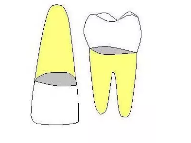 齲齒齲洞的5種類型 齲齒齲洞的5種類型