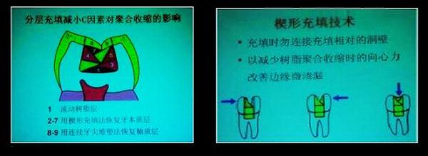 各類牙洞型樹脂修復(fù) 各類牙洞型樹脂修復(fù)