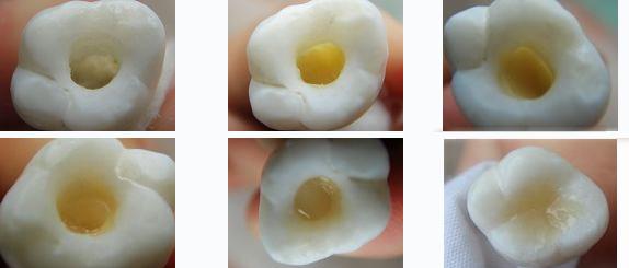 各類牙洞型樹脂修復(fù) 各類牙洞型樹脂修復(fù)