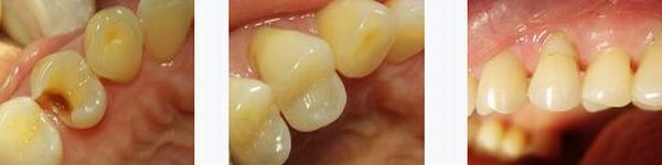 各類牙洞型樹脂修復(fù) 各類牙洞型樹脂修復(fù)