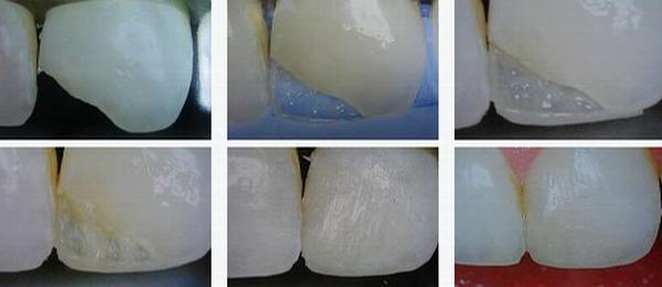 各類牙洞型樹脂修復(fù) 各類牙洞型樹脂修復(fù)