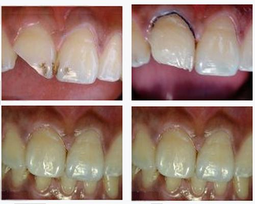各類牙洞型樹脂修復(fù) 各類牙洞型樹脂修復(fù)