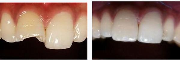 各類牙洞型樹脂修復(fù) 各類牙洞型樹脂修復(fù)