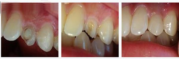 各類牙洞型樹脂修復(fù) 各類牙洞型樹脂修復(fù)