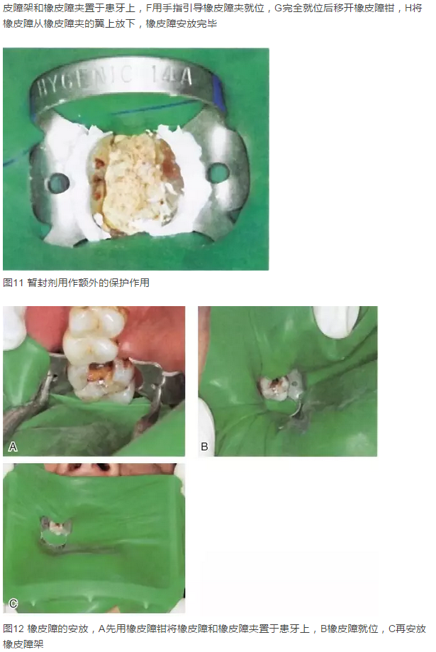 橡皮障隔離之單顆牙隔離方法——陳智教授 橡皮障隔離之單顆牙隔離方法——陳智教授