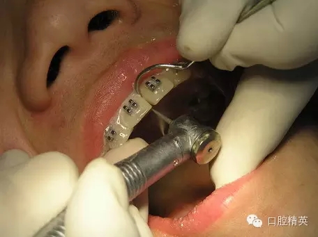 鄰面去釉臨床操作步驟組圖 鄰面去釉臨床操作步驟組圖