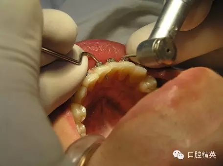 鄰面去釉臨床操作步驟組圖 鄰面去釉臨床操作步驟組圖