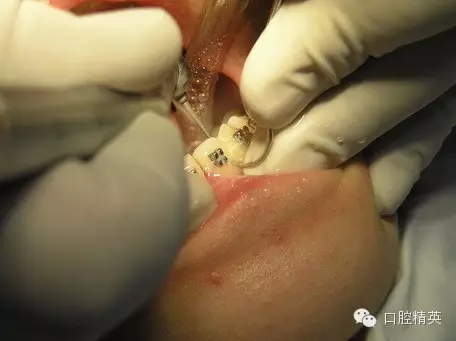 鄰面去釉臨床操作步驟組圖 鄰面去釉臨床操作步驟組圖