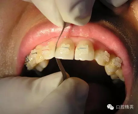 鄰面去釉臨床操作步驟組圖 鄰面去釉臨床操作步驟組圖