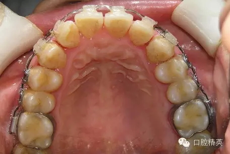 鄰面去釉臨床操作步驟組圖 鄰面去釉臨床操作步驟組圖