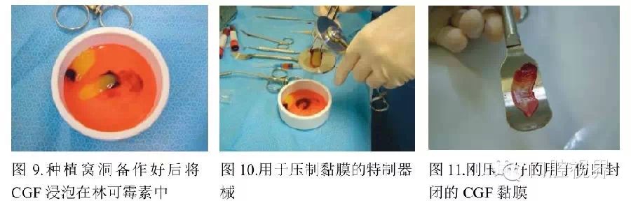 知道PRP?知道PRF?知道CGF? 知道PRP?知道PRF?知道CGF?