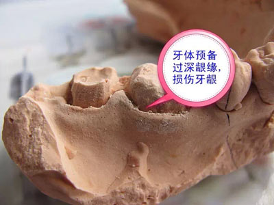 備牙應注意的事項+備牙取摸損傷牙齦問題 備牙應注意的事項+備牙取摸損傷牙齦問題