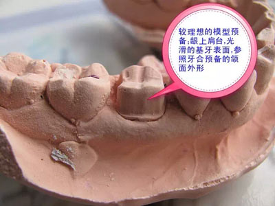 備牙應注意的事項+備牙取摸損傷牙齦問題 備牙應注意的事項+備牙取摸損傷牙齦問題